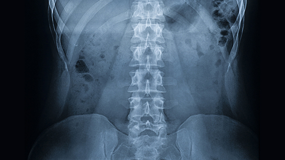 Ankylosing Spondylitis