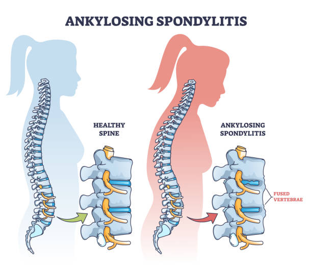 Best Ankylosing Spondylitis Treatment in Ahilyanagar